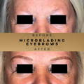 MICROBLADING EYEBROWS WILMSLOW Before & After Wilmslow, Cheshire Dr Sknn Aesthetic
