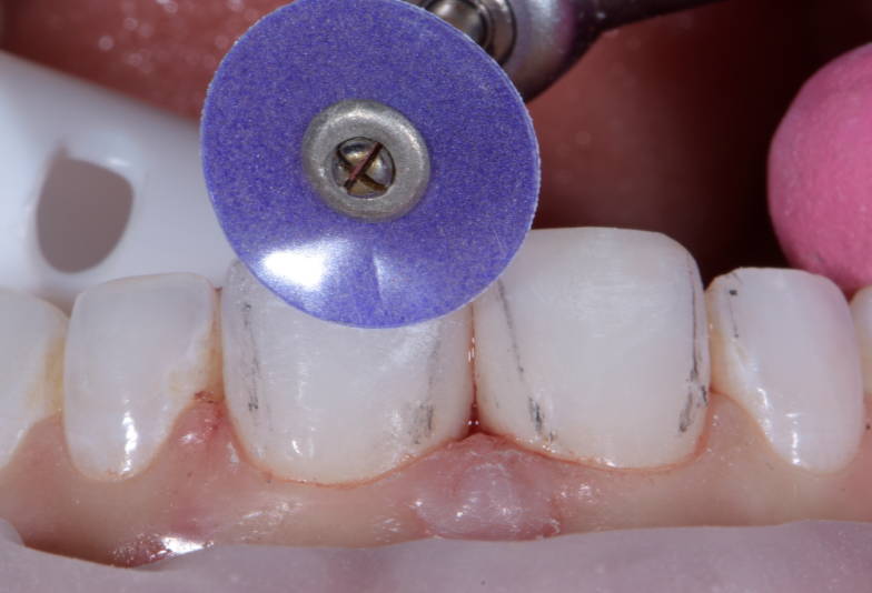 Purple polisher polishing upper anterior tooth