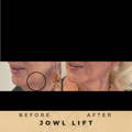 Jowl Fillers Wilmslow Dr Sknn Before & After Picture