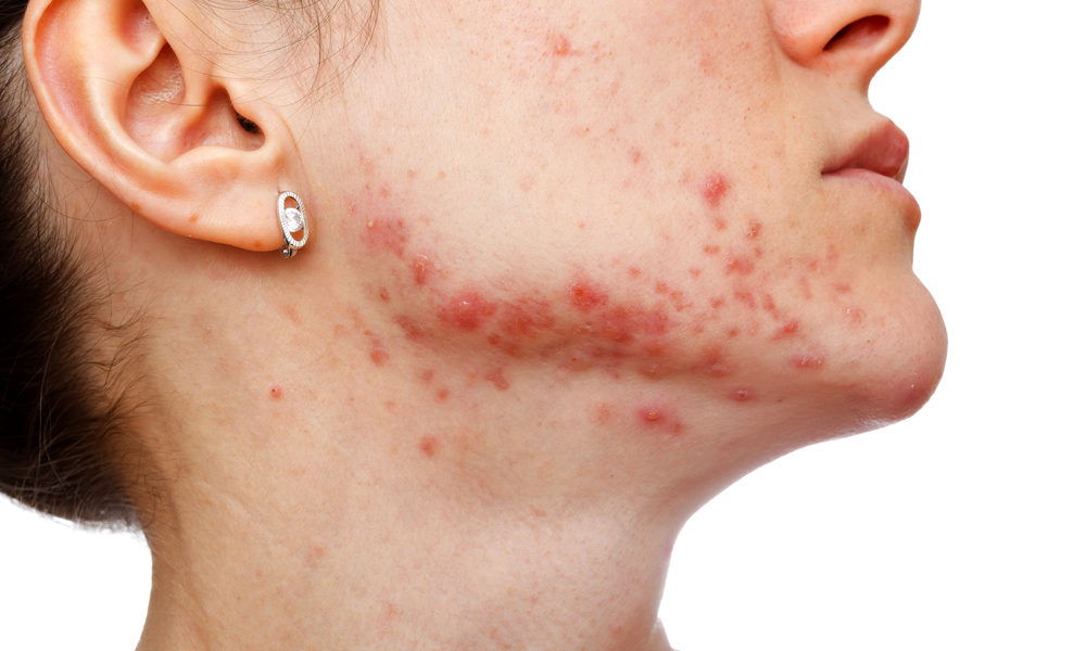 Woman with Acne in her face