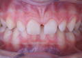 Patient bite showcasing microdontia