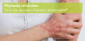 Pityriasis versicolor Kleienpilzflechte