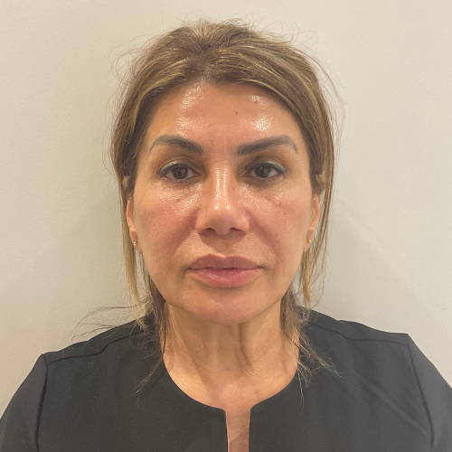 CHEEK, NASOLABIAL & JOWL FILLER AFTER
