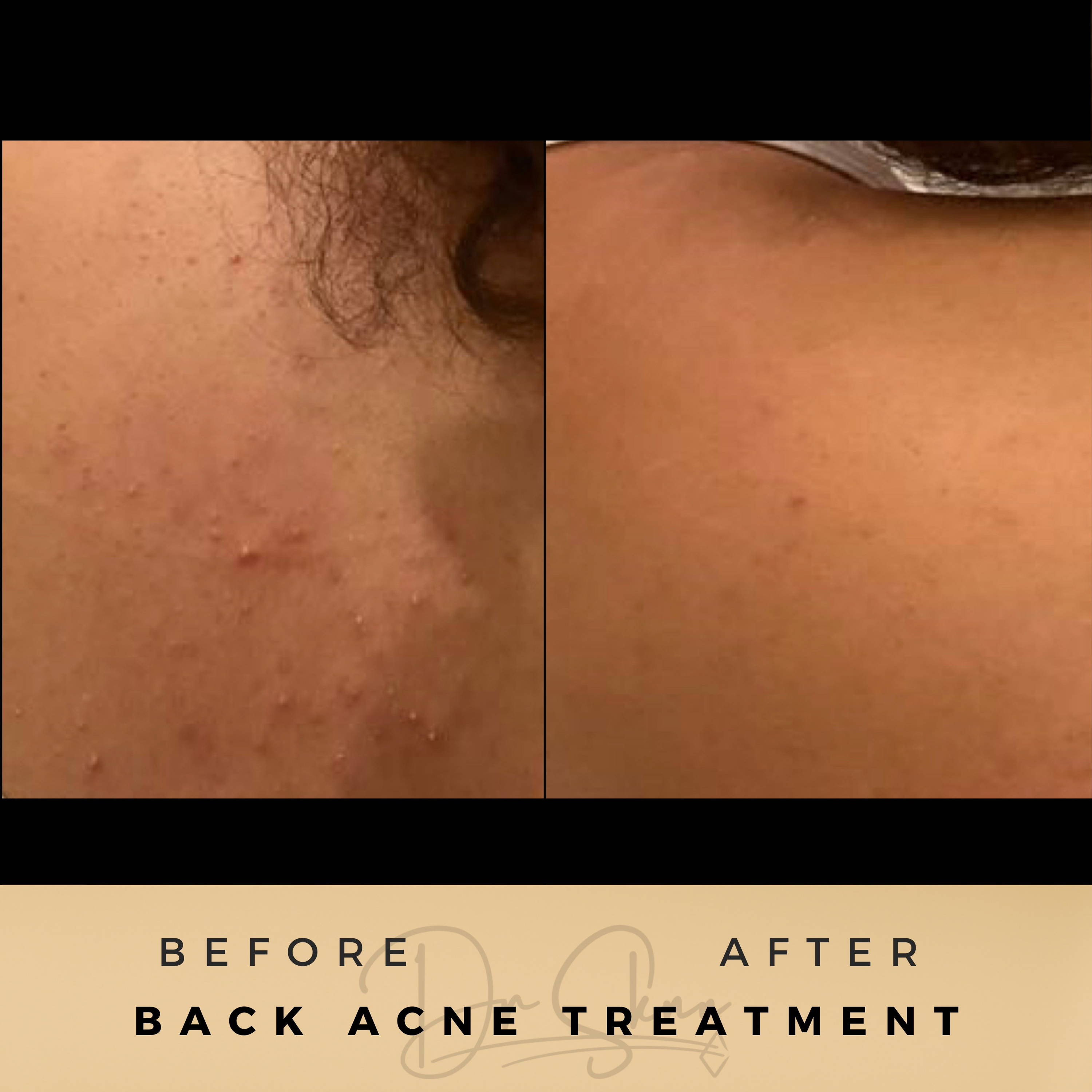 Acne Treatment - Dr Sknn before and after
