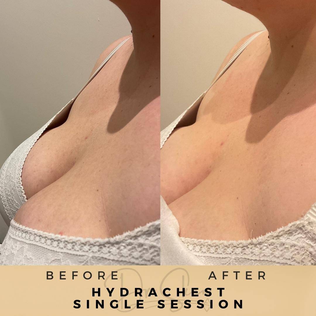 HydraFacial - Dr Sknn before and after