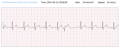 EKG-Wellenform von PVC