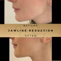 Jaw Line Reduction Wilmslow Dr Sknn Before & After Picture