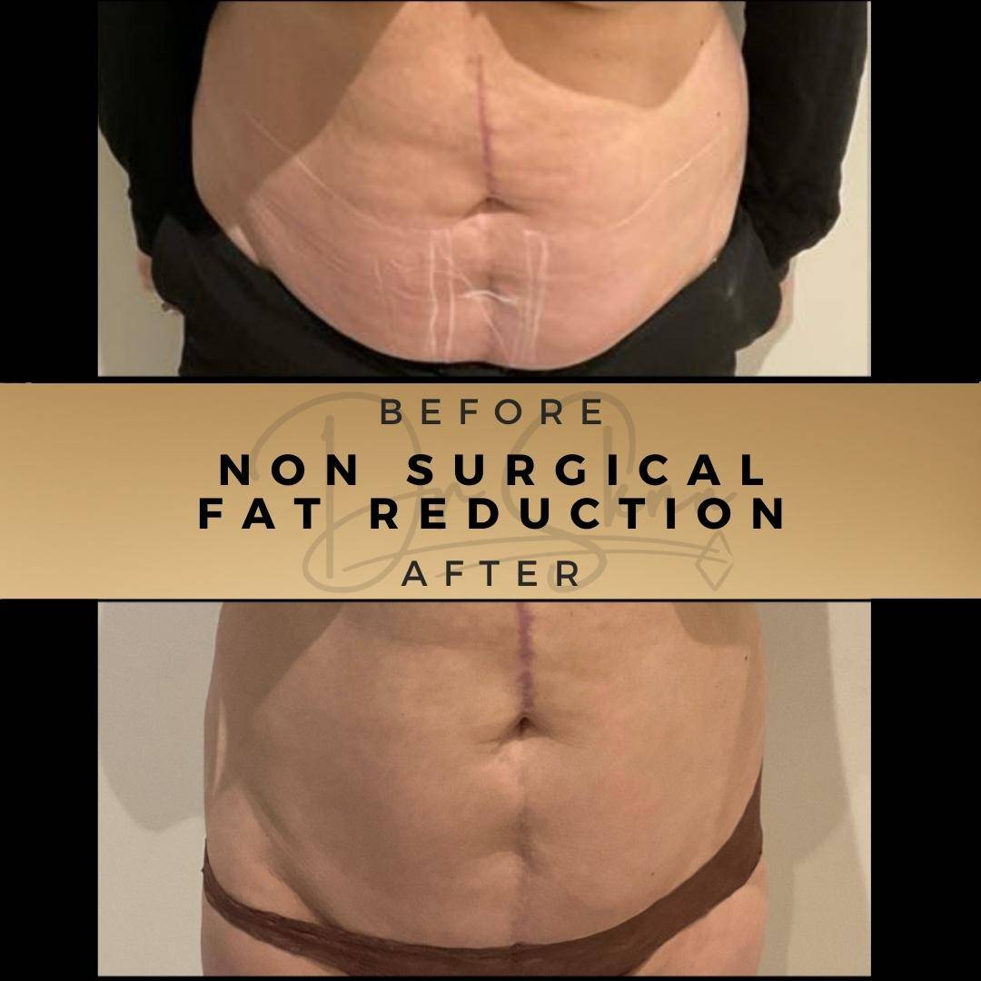 Fat Reduction Non Surgical Wilmslow