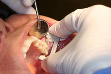 Hand with gloves performing procedure in patient's tooth using a grey polishing strip