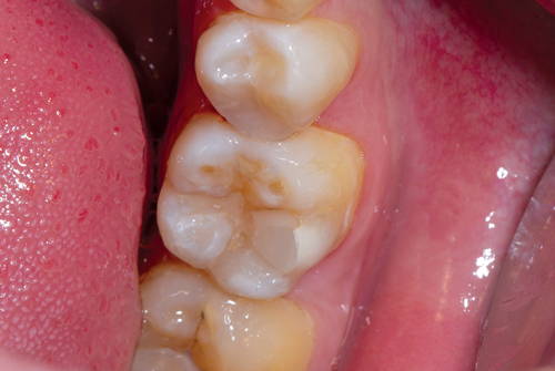 Buccal view of final result