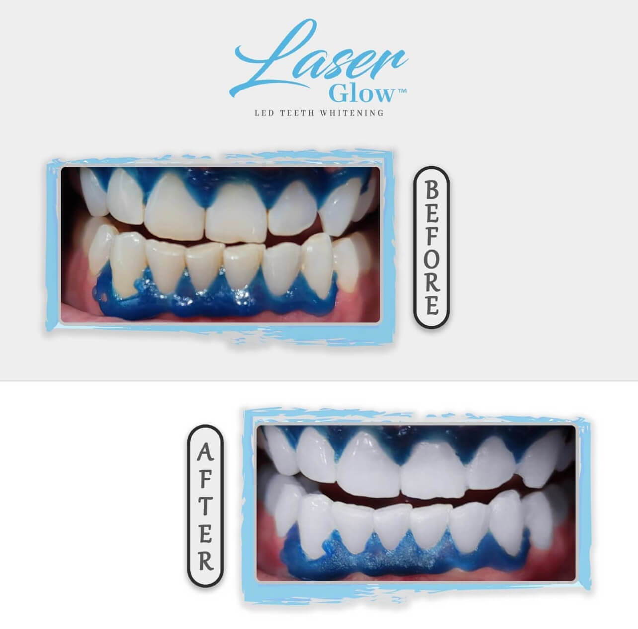 laserglow in office teeth whitening reviews