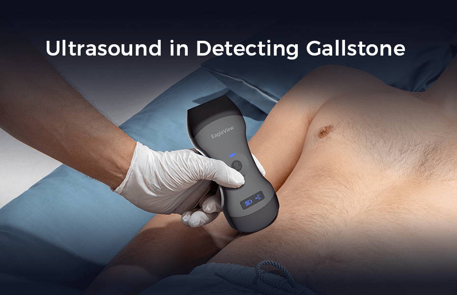 The Application of EagleView Handheld Ultrasound in Gallbladder