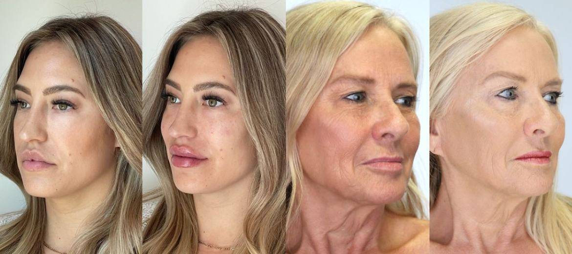 botox, juvederm before and after images