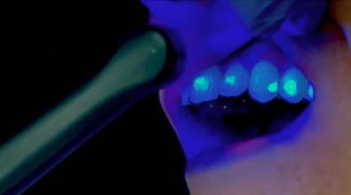 VALO handpiece curing teeth