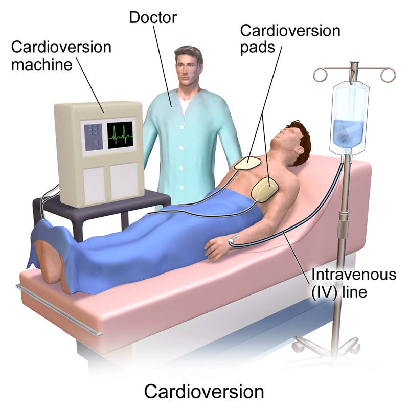 Cardioversión eléctrica