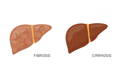 fibrosis and cirrhosis liver