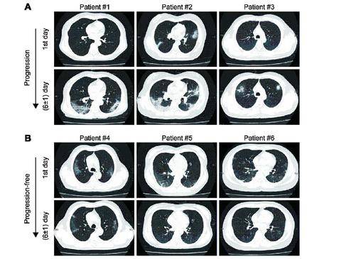 Predictors for imaging progression on chest CT from coronavirus disease 2019 (COVID-19) patients
