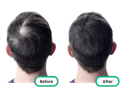 before and after of the top of a man's head after using the best tea tree oil singapore