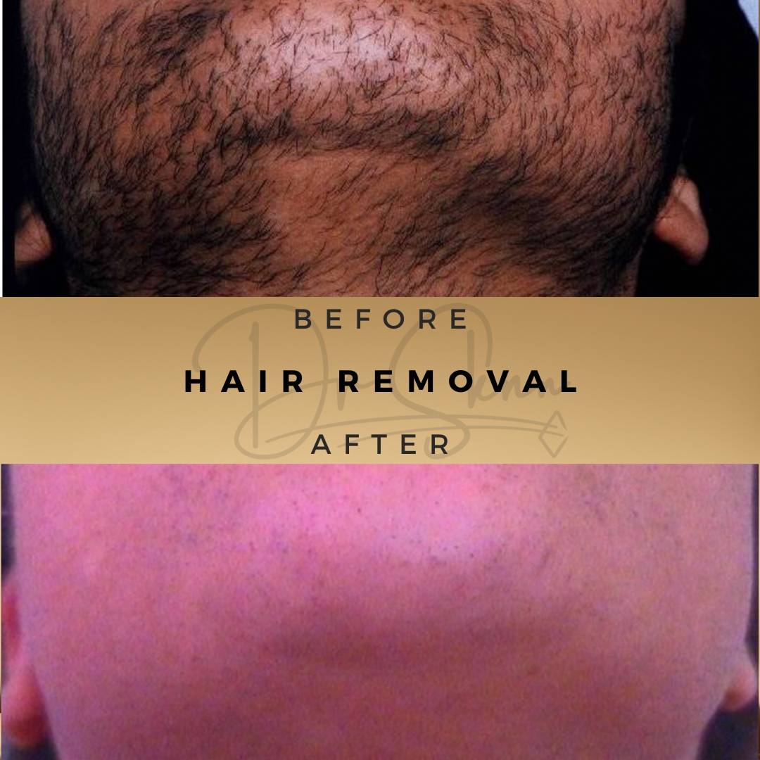 Laser Hair Removal Wilmslow Before & After Dr Sknn