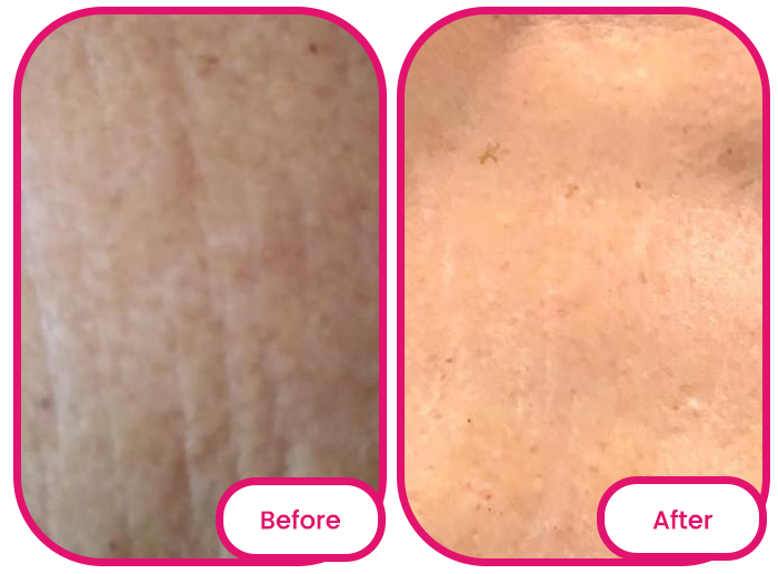 skin before and after taking the best collagen gummies singapore