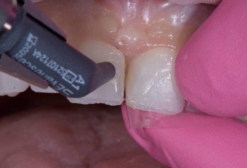 Composite compule applying material to tooth