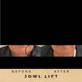 Jowl Fillers Wilmslow Dr Sknn Before & After Picture