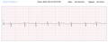 ECG anormaux, ECG anormaux, bandelettes ECG anormales, bandelettes ECG anormales,