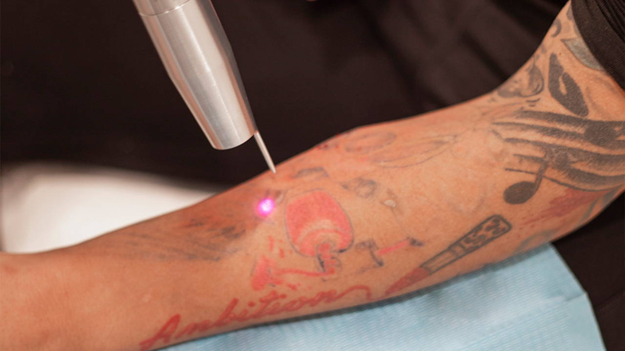 tattoo removal technique 