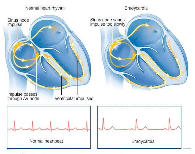 bradycardie vs rythme cardiaque normal