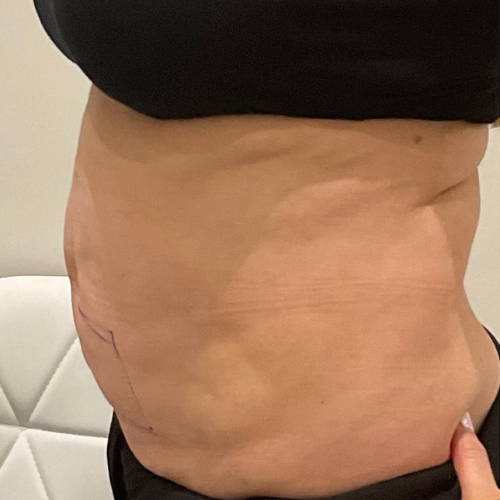 Dr Sknn Fat Reduction Belly Before