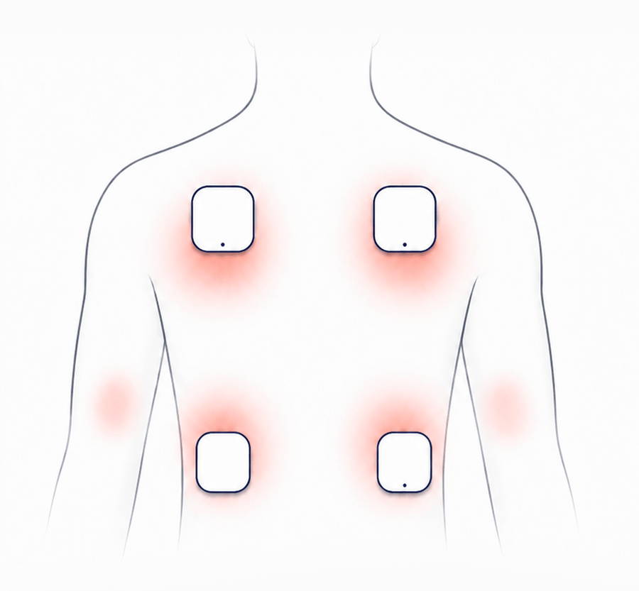 Four-channel TENS setup with independent intensity control across four treatment areas.