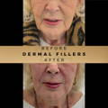 Marionette Line Filler Wilmslow Before & After Dr Sknn