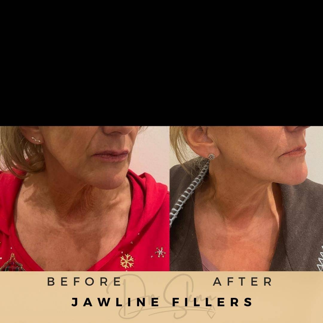 Jawline Fillers - Dr Sknn before and after