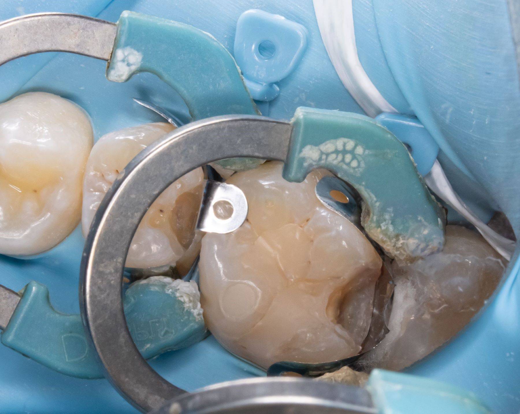 Matrix ring placed in tooth 