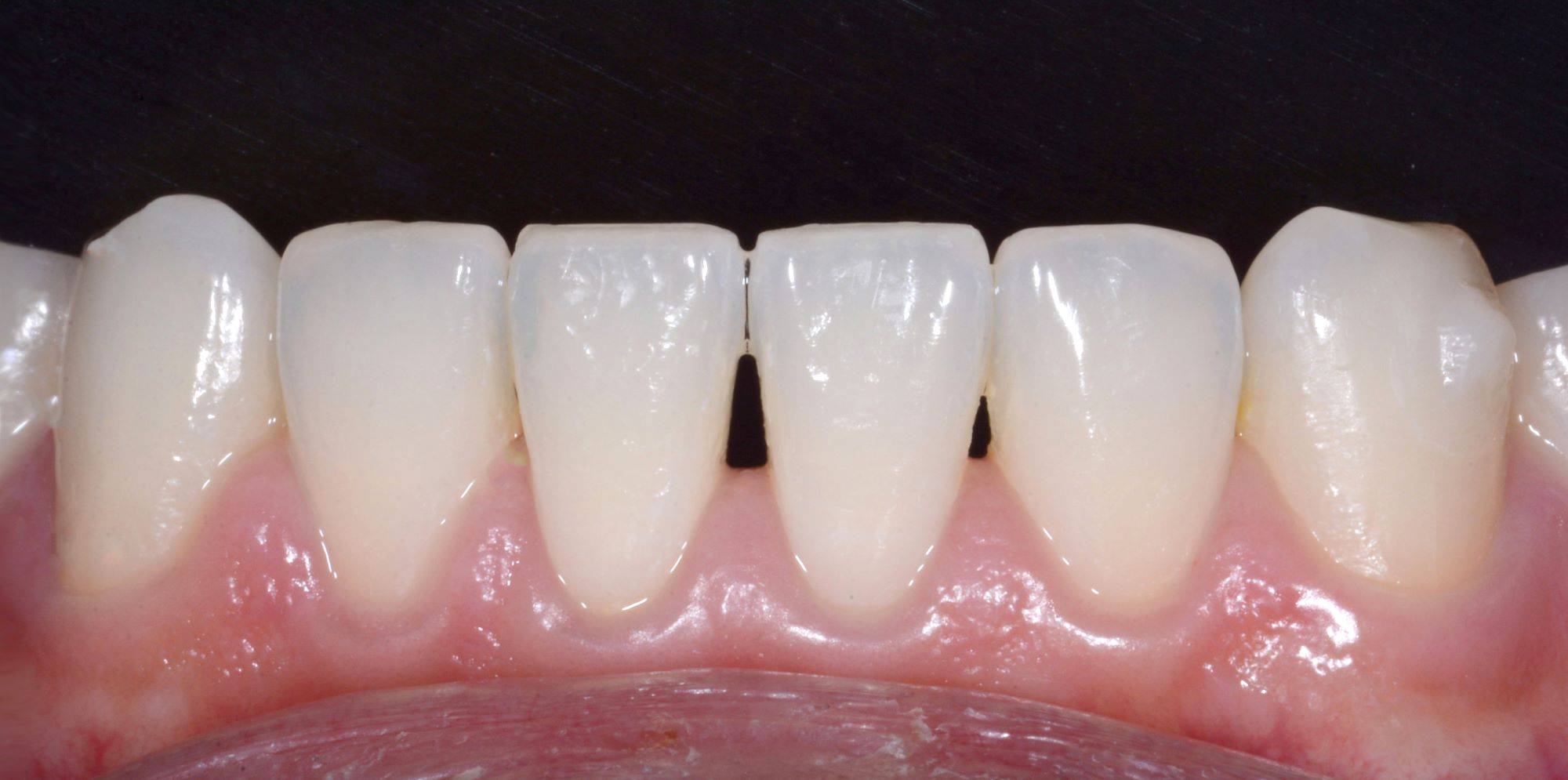 Close-up on smile showcasing small black triangle in lower central incisor
