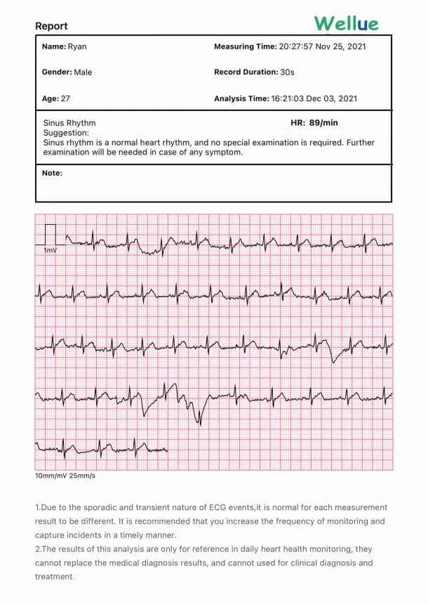 Informe de electrocardiograma