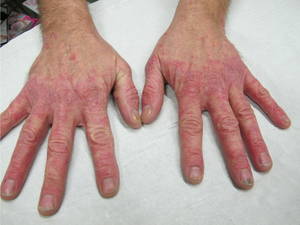 Dr Sknn Dermalux Tri-Wave MD Before Psoarisis