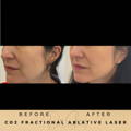 Pigmentation Treatment Co2 Fractional Laser Wilmslow Dr Sknn Before & After Picture