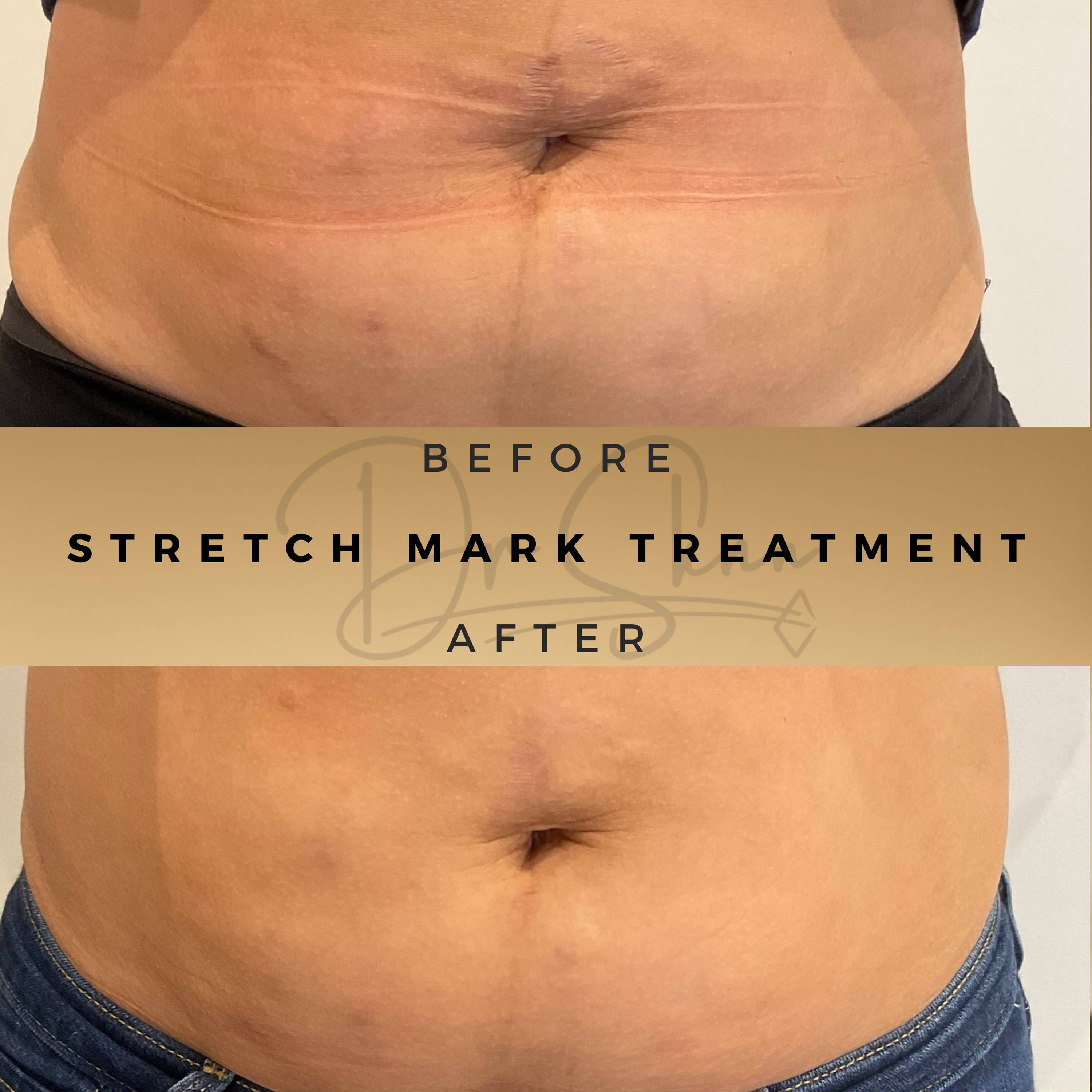 Stretch Mark Treatment Wilmslow Before & After Dr Sknn