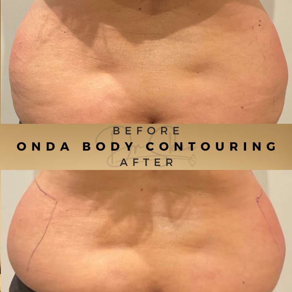 Body Contouring Non Surgical Wilmslow Before & After Pictures Dr Sknn - Onda treatment