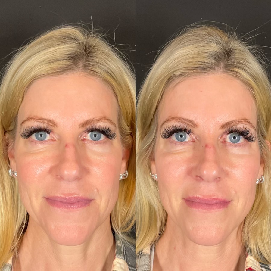Full Facial Balancing with Radiesse for Temples transformation