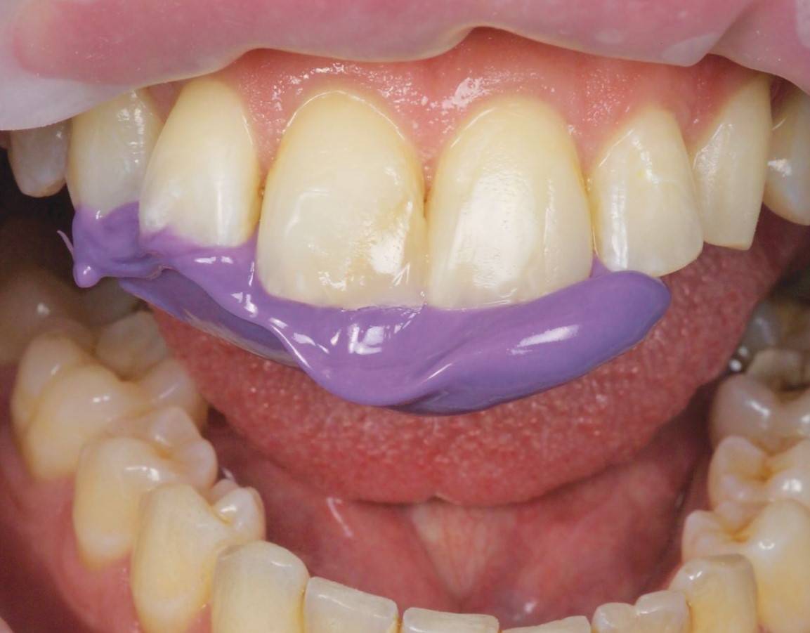 Mouth open with purple material attached to upper teeth