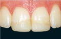 upper teeth before restoration in black background