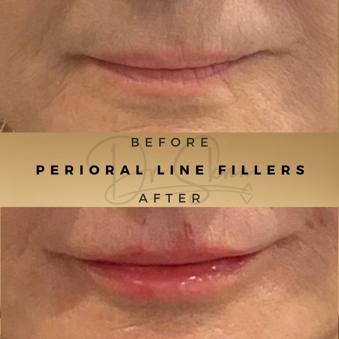 Perioral Line Fillers Wilmslow Before & After Dr Sknn