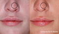 Red dot on woman's nose  before and after Lumecca IPL