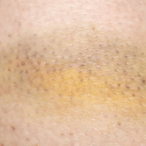 Bruise healing progress after three treatments with a laser pain relief device