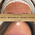 Forehead Anti-Wrinkle Injections Wilmslow