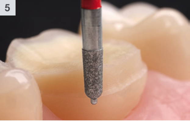 8849P bur preparing buccal and lingual sides of a tooth