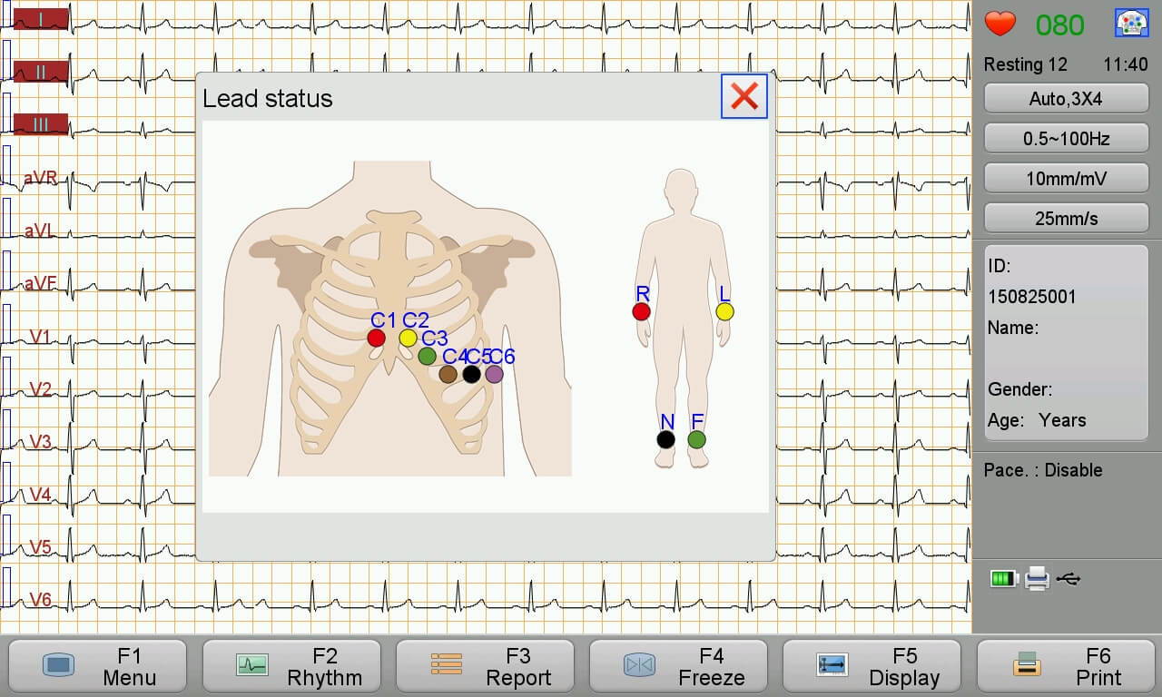 Anleitung zur EKG-Platzierung auf dem Bildschirm