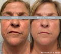 Woman's face before and after Morpheus8